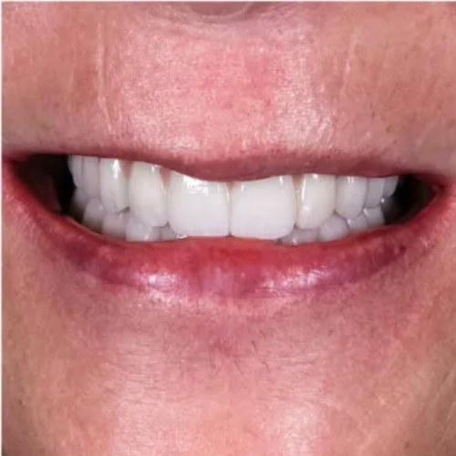 Closer view of a successful dental implant