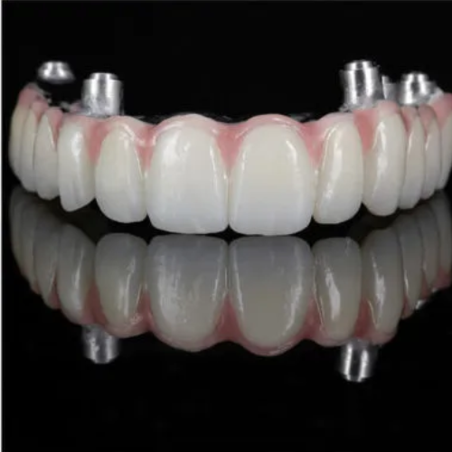 Dental implant example